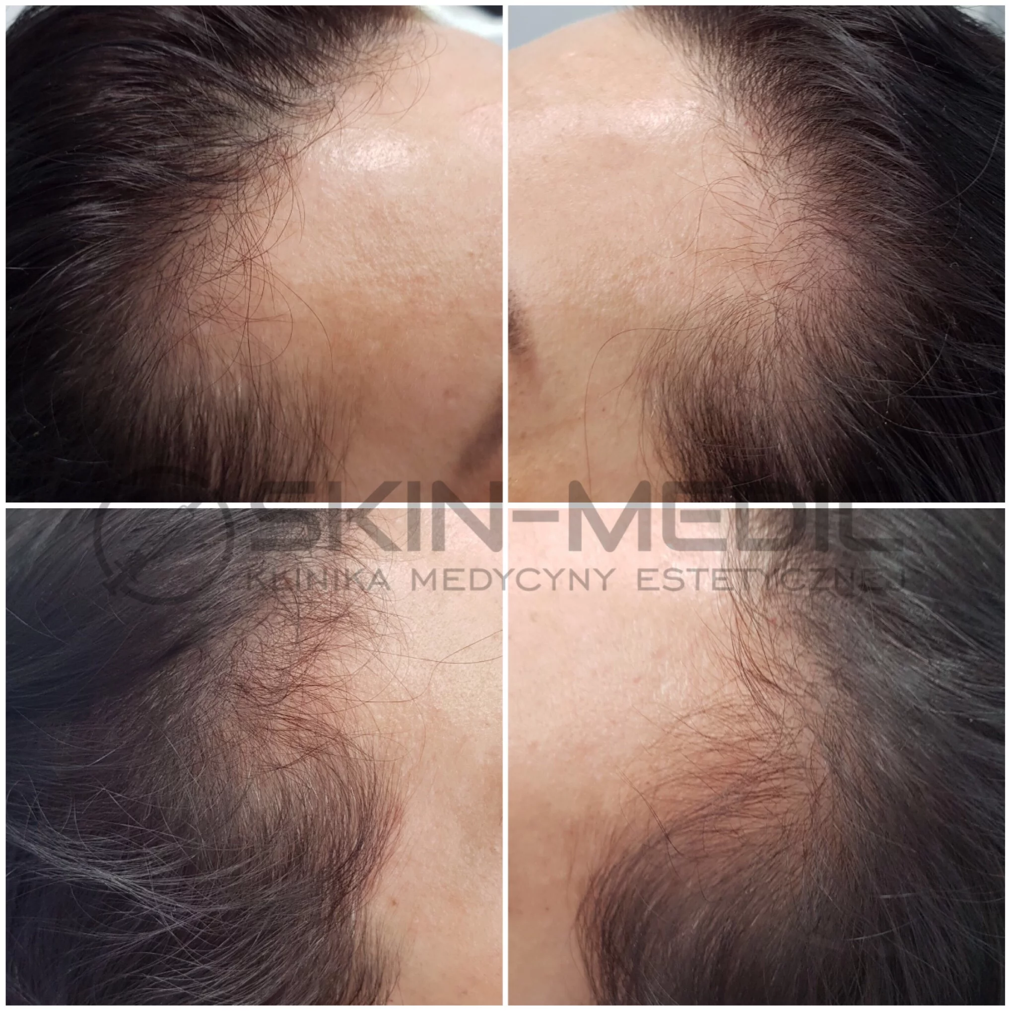 Mezoterapia igłowa głowy efekty