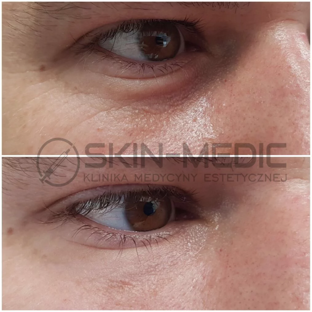 Wypełnienie doliny łez efekty