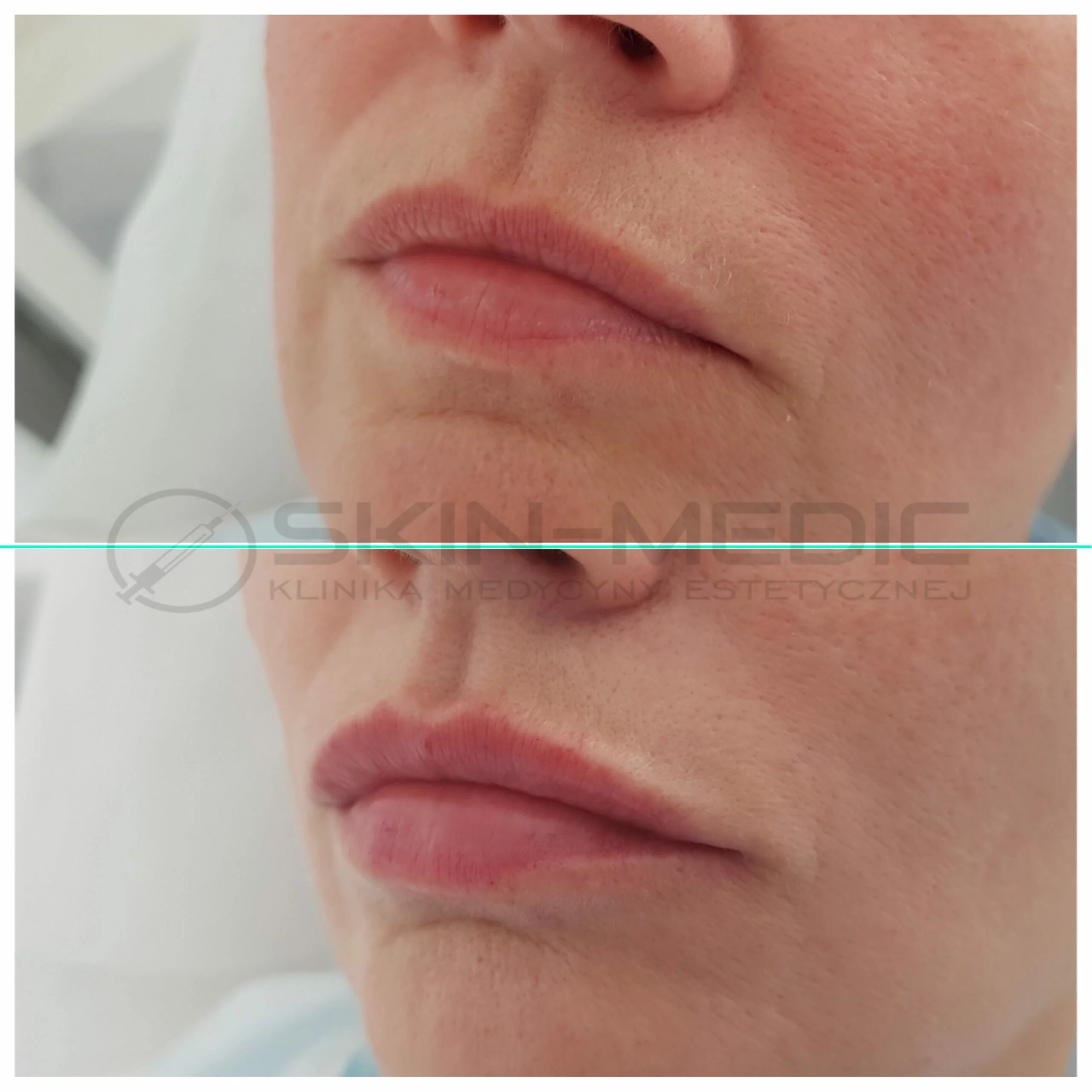 Modelowanie ust efekty