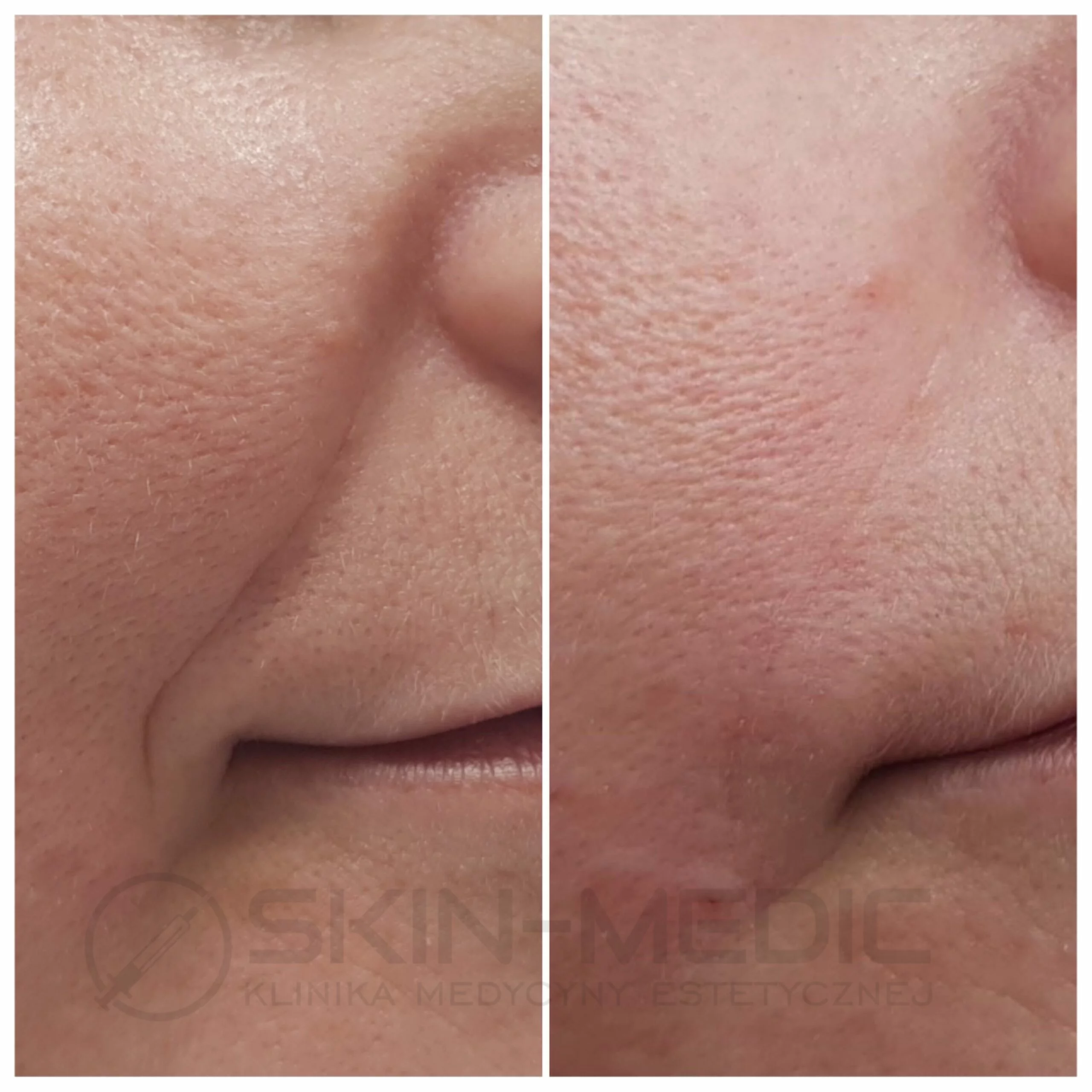 Zmarszczki palacza przed i po