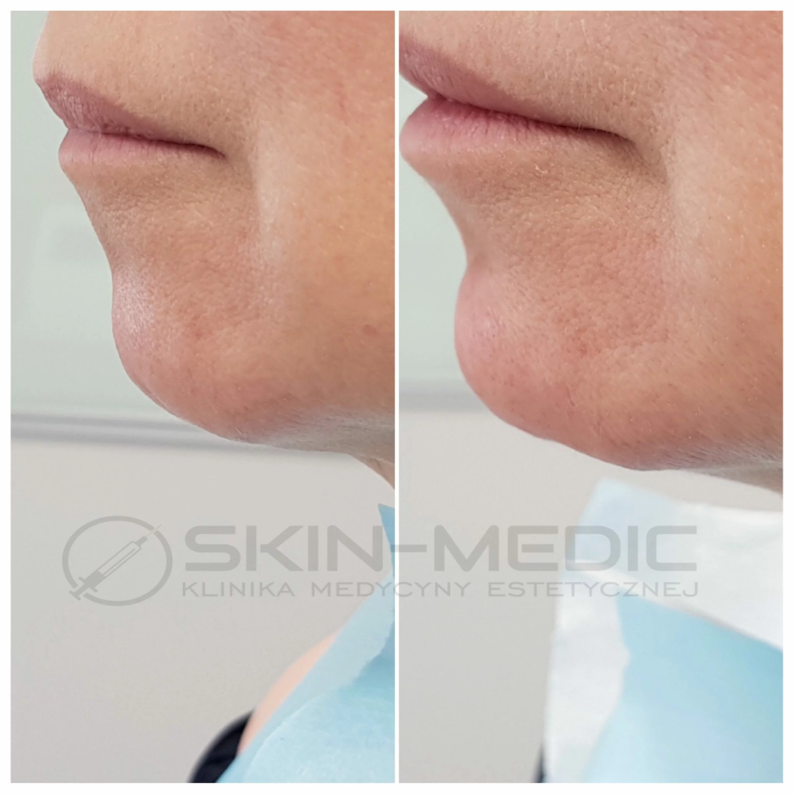 Korekta brody Poznań