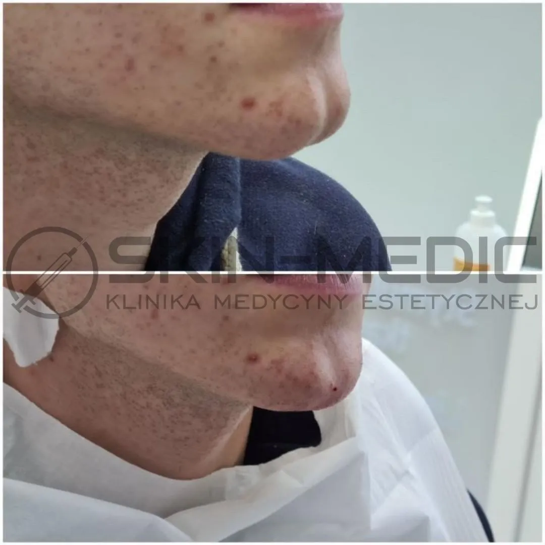 Modelowanie brody przed i po Poznań