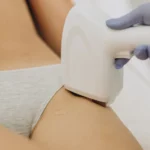 bikini po depilacji laserowej