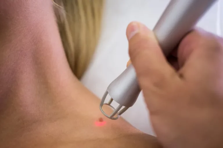 nowe pieprzyki dlaczego się pojawiają